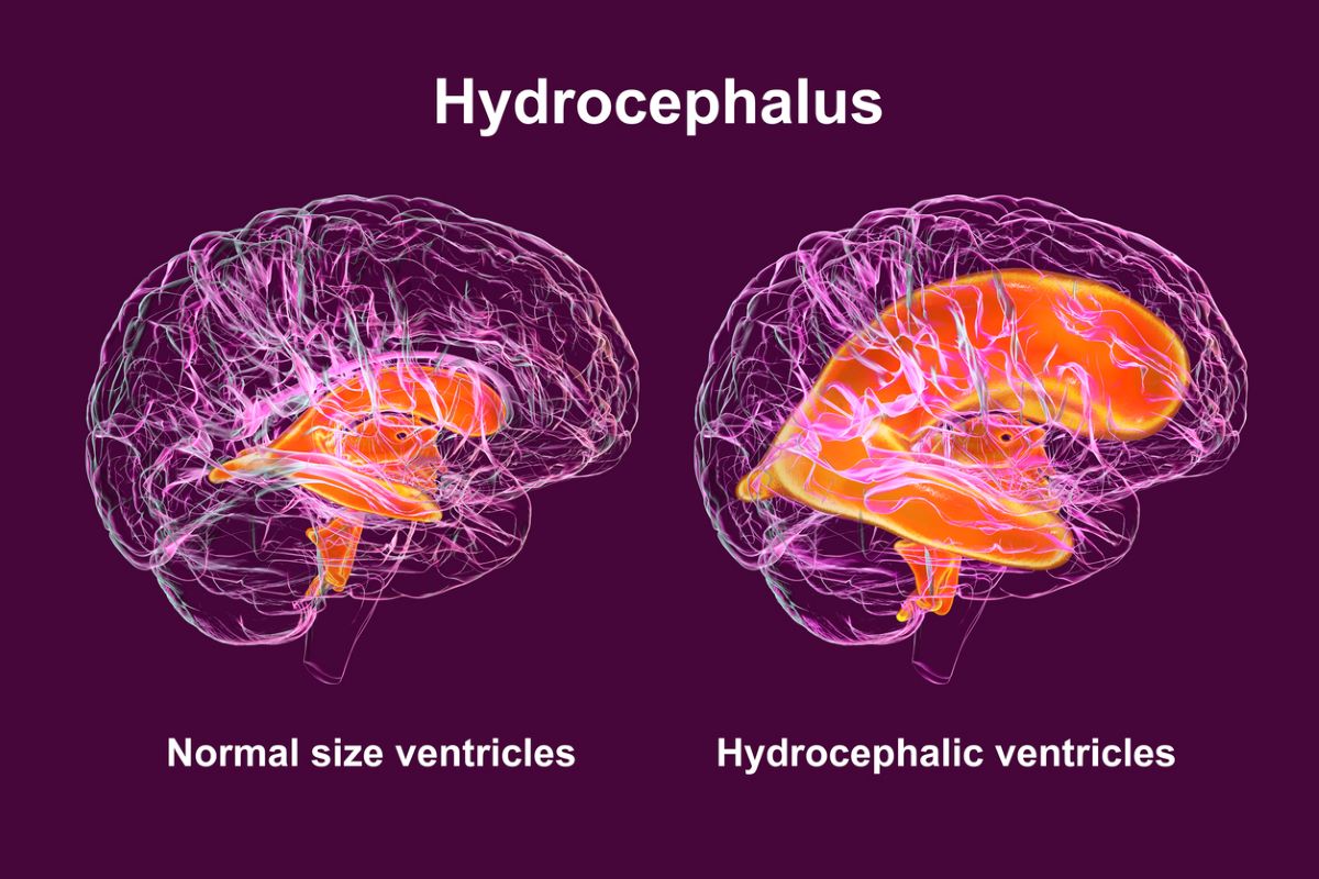 Hydrocéphalie coupe du cerveau excès de liquide cérébro-spinal